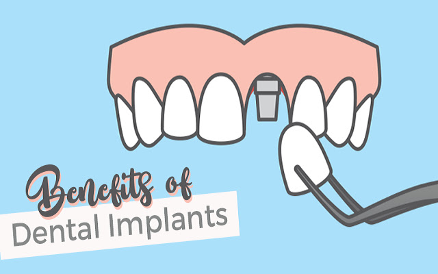 Benefits of Dental Implants from Chrome web store to be run with OffiDocs Chromium online Benefits of Dental Implants from Chrome web store to be run with OffiDocs Chromium online